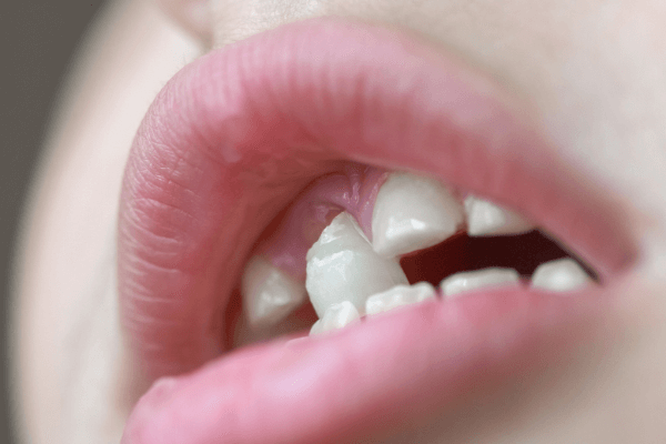  歯の夢を見る意味：その意味を解釈する方法を知る