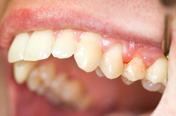  Sapņot par asiņojošu zobu - ko tas nozīmē? Atbildes, šeit!
