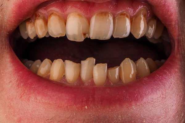  Snívať o pokazenom zube - Čo to znamená? Pozrite sa sem!